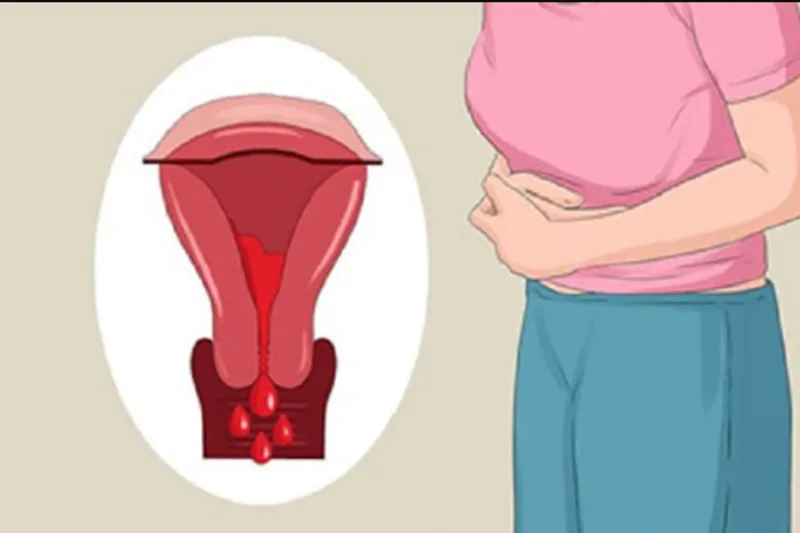 Mỗi người có nguyên nhân rong kinh khác nhau, vì vậy cần theo dõi triệu chứng và đi khám khi có dấu hiệu bất thường.